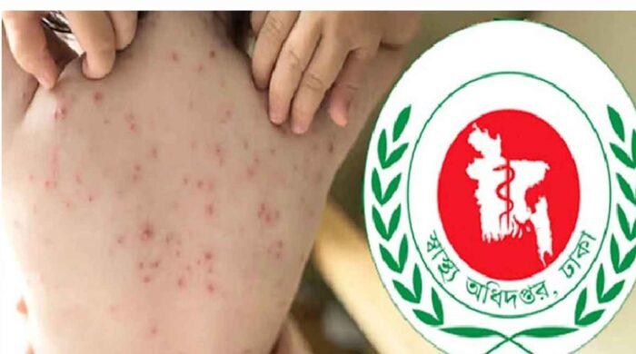দেশে বাড়ছে হাম,২৪ ঘন্টায় মৃত্যু ৭
